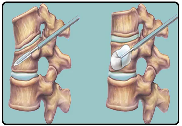 Vertebroplasty