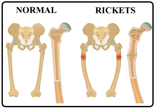 Rickets